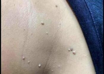 Ai đang bị mụn thịt thừa ở cổ - mặt - nách - tay chân...chữa mãi ko hết thì lh e...