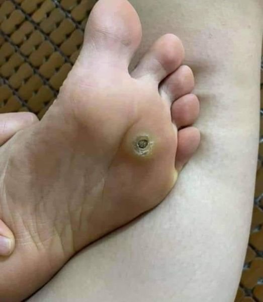 Em đã từng bị như thế này
Đau nhói rất khó chịu cả 2 năm trời
Đi đốt laze kh...