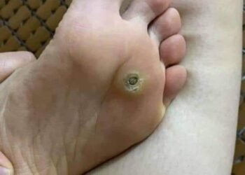 Em đã từng bị như thế này 
 Đau nhói rất khó chịu cả 2 năm trời 
 Đi đốt laze kh...