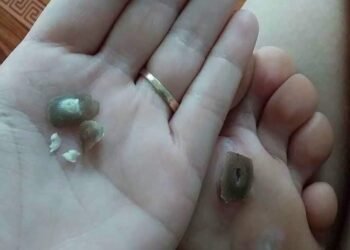 Em đã từng bị như này 
 Đau nhói rất khó chịu cả 2 năm trời 
 Đi đốt laze không ...