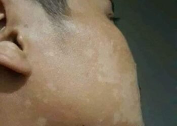 Đ.ặc trị . bạch biến lang ben 
 Chỉ cần 1lo .trị dứt điểm trong 10 ngày 
 Ai cần...