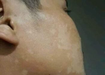 Đặc trị bệnh bạch biến,lang ben 
 Thuốc đông y gia truyền chuyên đặc trị bệnh bạ...