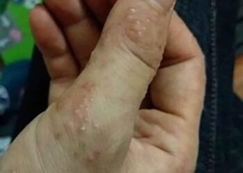 Bao nhiêu năm khổ sở vì bệnh này, bao nhiêu thuốc không Khỏi, tái đi tái lại
 Ai...