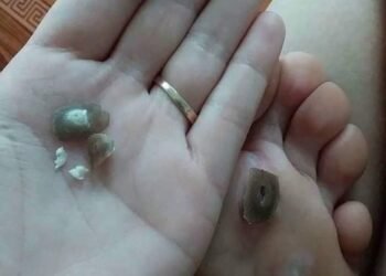 Chỉ cần 1 lọ thôi ạ .
 Tẩy sạch: 
 _ Mụn cóc
 _Mắt cá
 _Nốt ruồi 
 _Mụn thịt
 Gi...